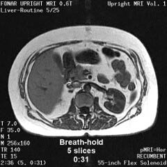 Liver MRI