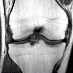 MRI of the Knee