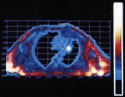 Figure 25. Carcinoma of the left upper lobe with peripheral consolidation. 